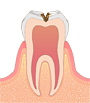 虫歯の中期＝「Ｃ2」